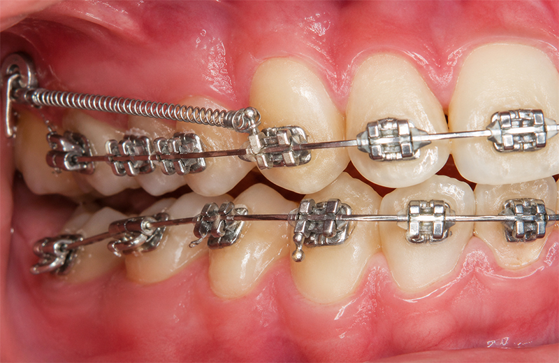 Mini Implantes Ortodônticos