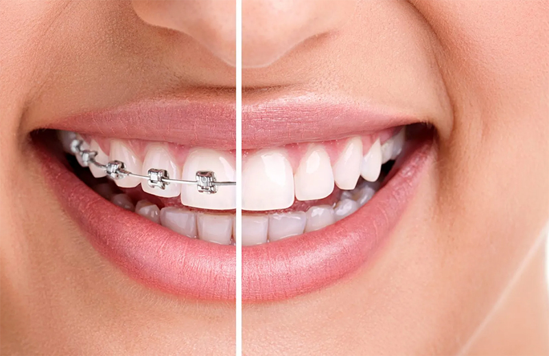 harmonia facial ortodentia preventiva